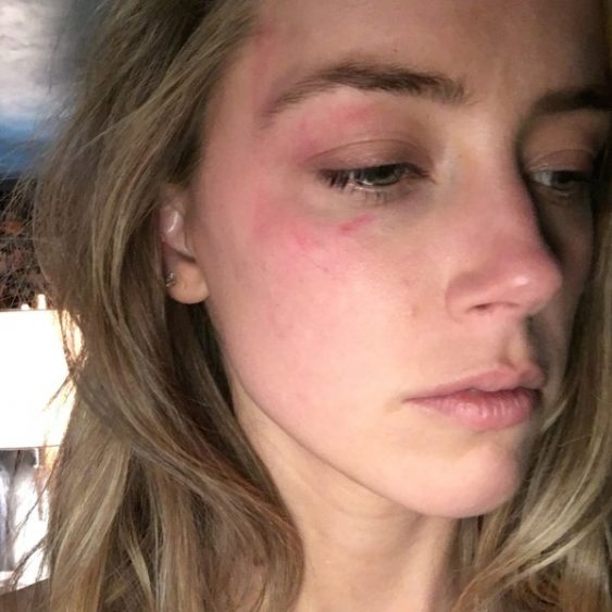 A imagem de Amber Heard alegadamente entregue em tribunal para provar que a atriz foi vítima de agressões por parte do ainda marido 
