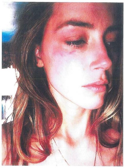 Amber Heard acusou Johnny Depp de violência física e psicológica. Esta é a foto que usou em tribunal para prová-lo. / Reuters 
