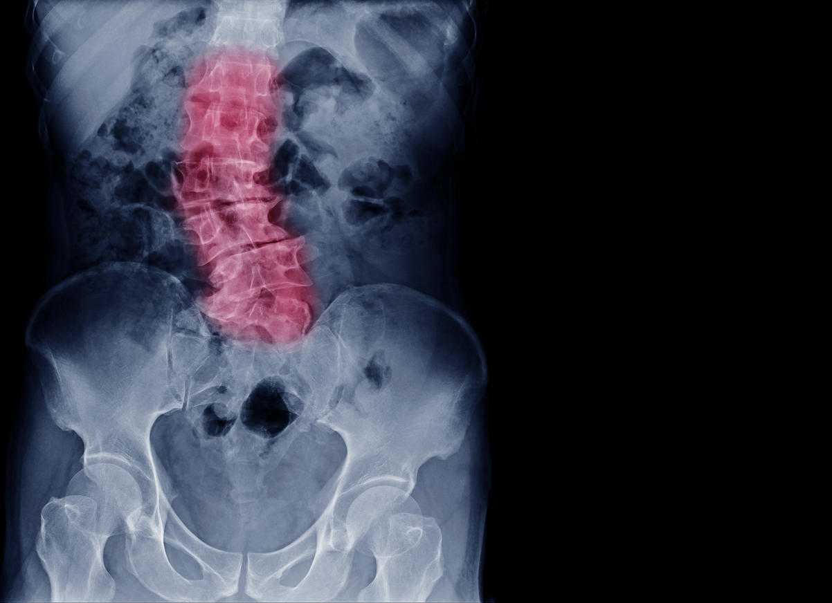 X-ray image of elder patient spine show Scoliosis and spinal bend in old people. Process in blue tone spine mark in red color and have copy space, Medical concept.