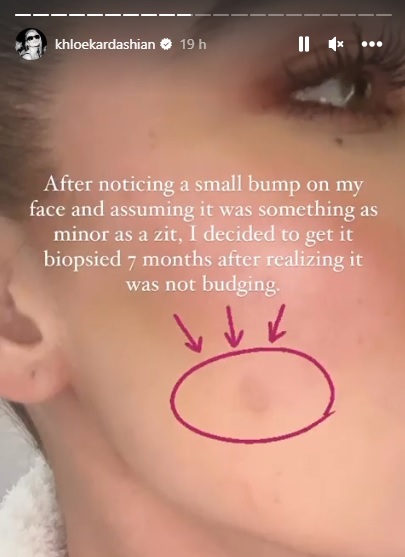 Khloe Kardashian tumor maligno rosto face