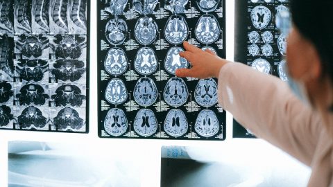 células cerebrais Alzheimer Parkinson estudo